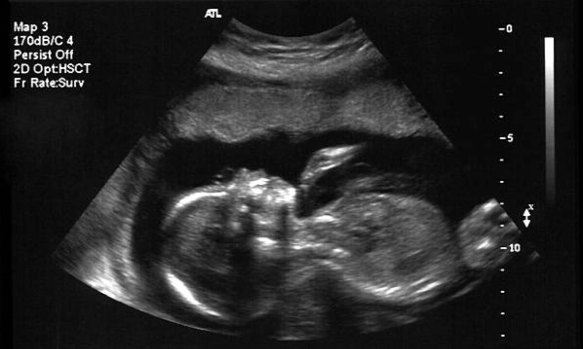 Ultrasound scan in Bangalore