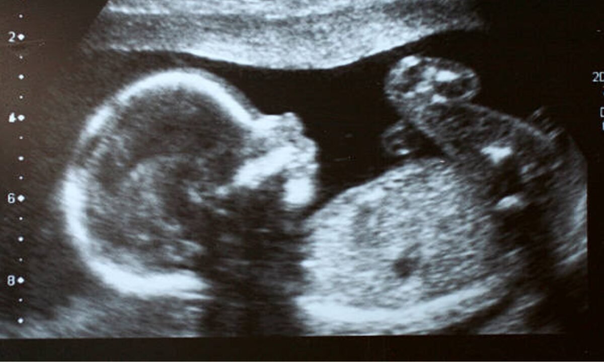 Ultrasound scan in Bangalore