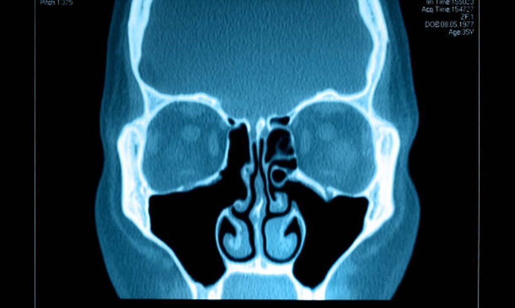 sinus ct scan
