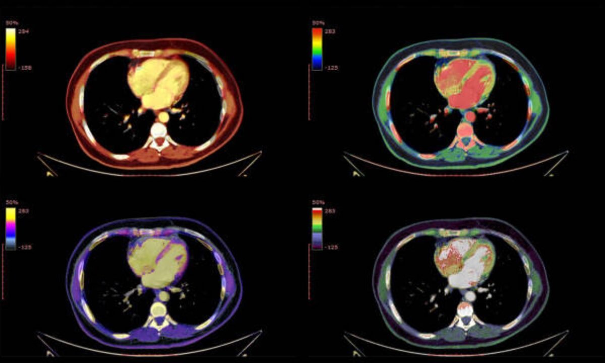 PET CT Scan in Bangalore