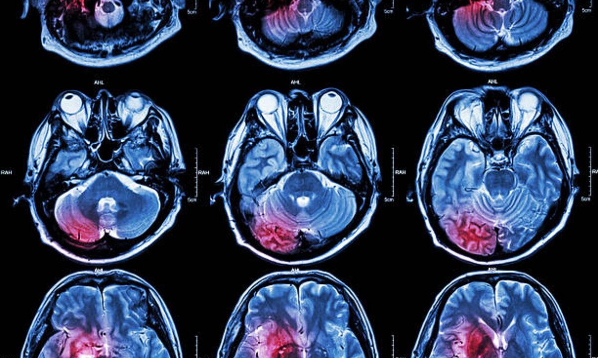 CT scan in Bangalore 