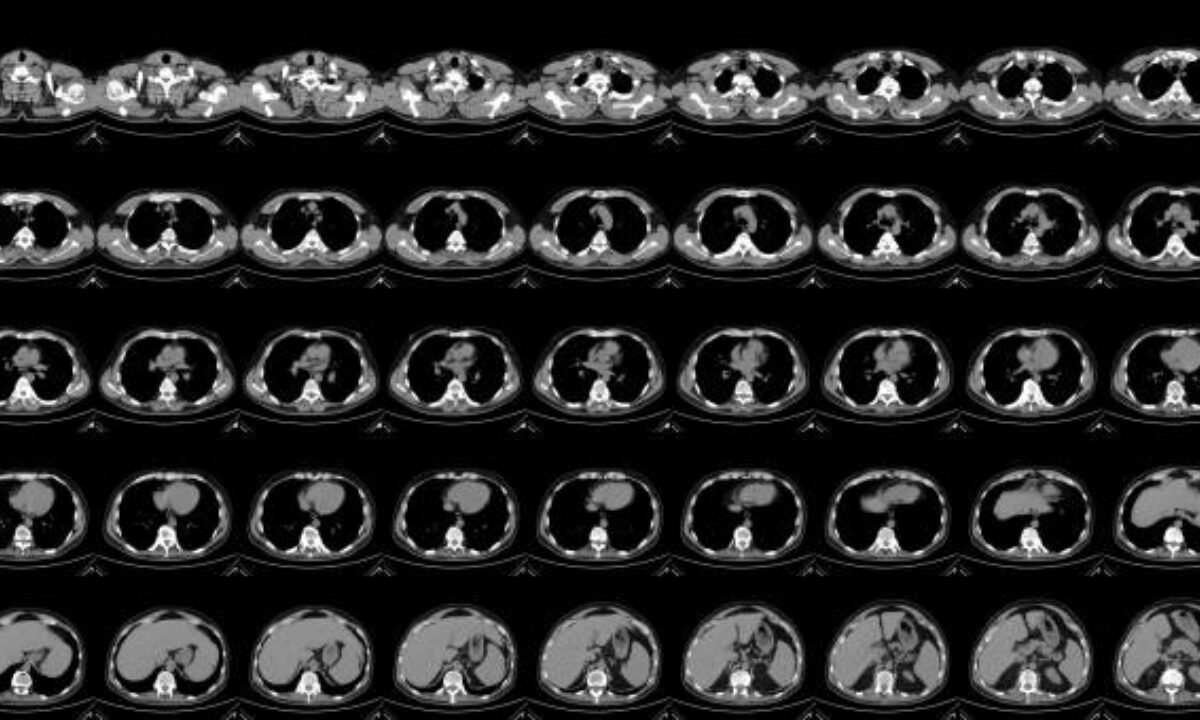 PET CT scan in Bangalore