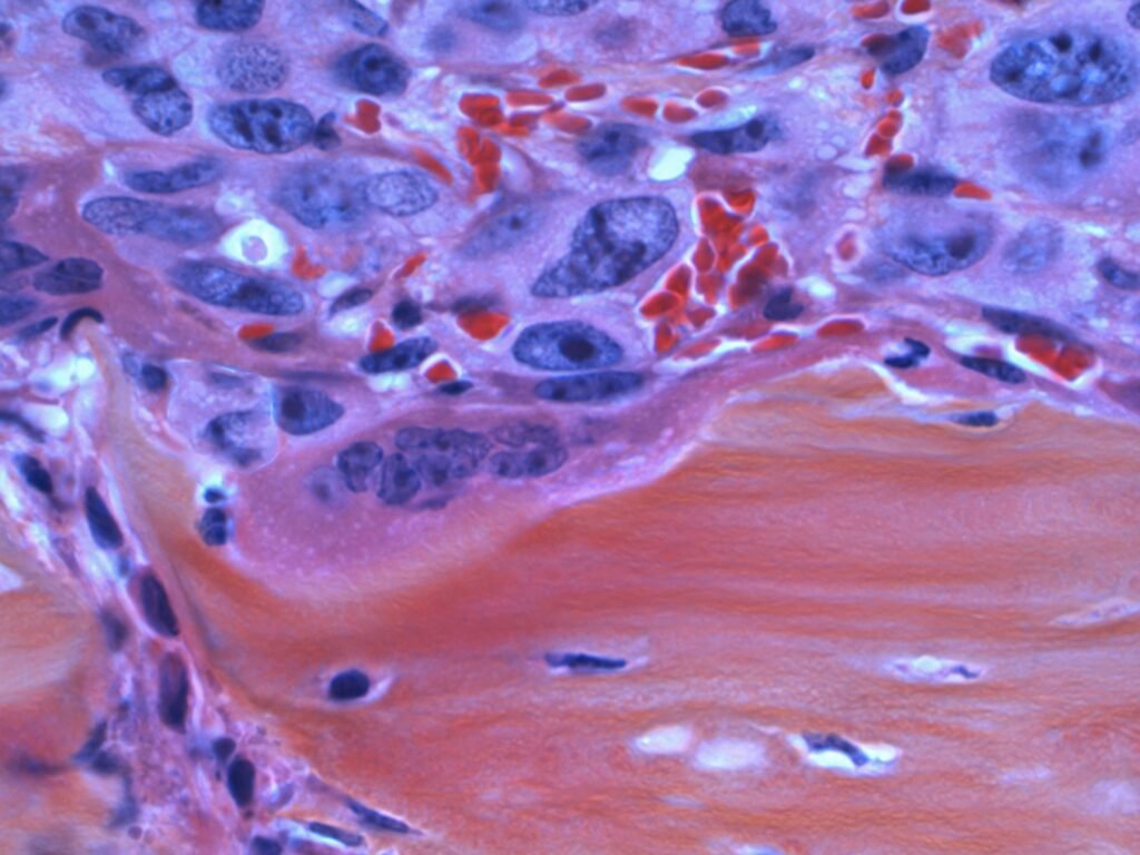 Mammography in Bangalore
