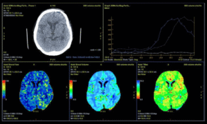 How Brain PET Scans Help Diagnose Neurological Disorders Koshikaa