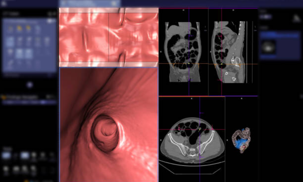 Understanding the colonoscopy