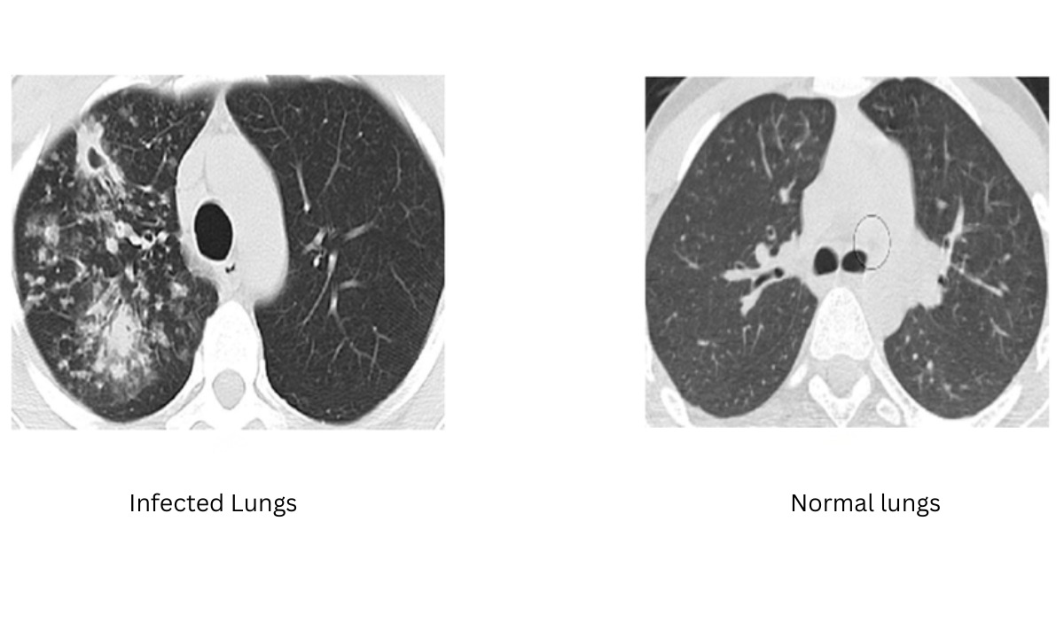 What You Should Know About TB
