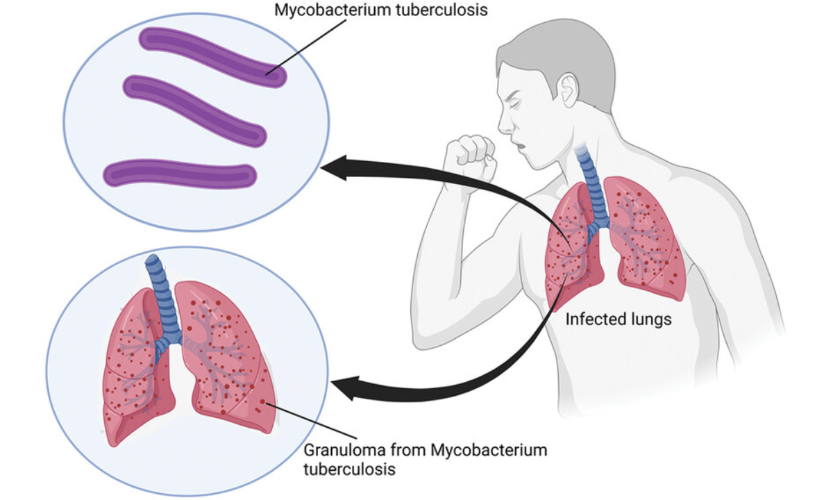 What You Should Know About TB