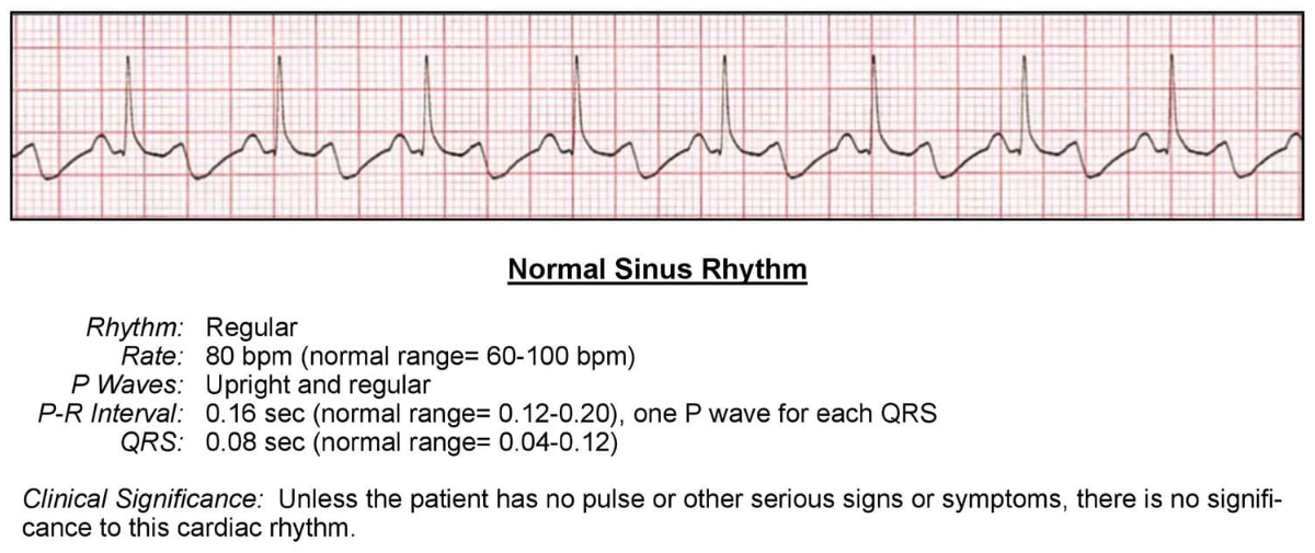 Normal ECG Values Explained