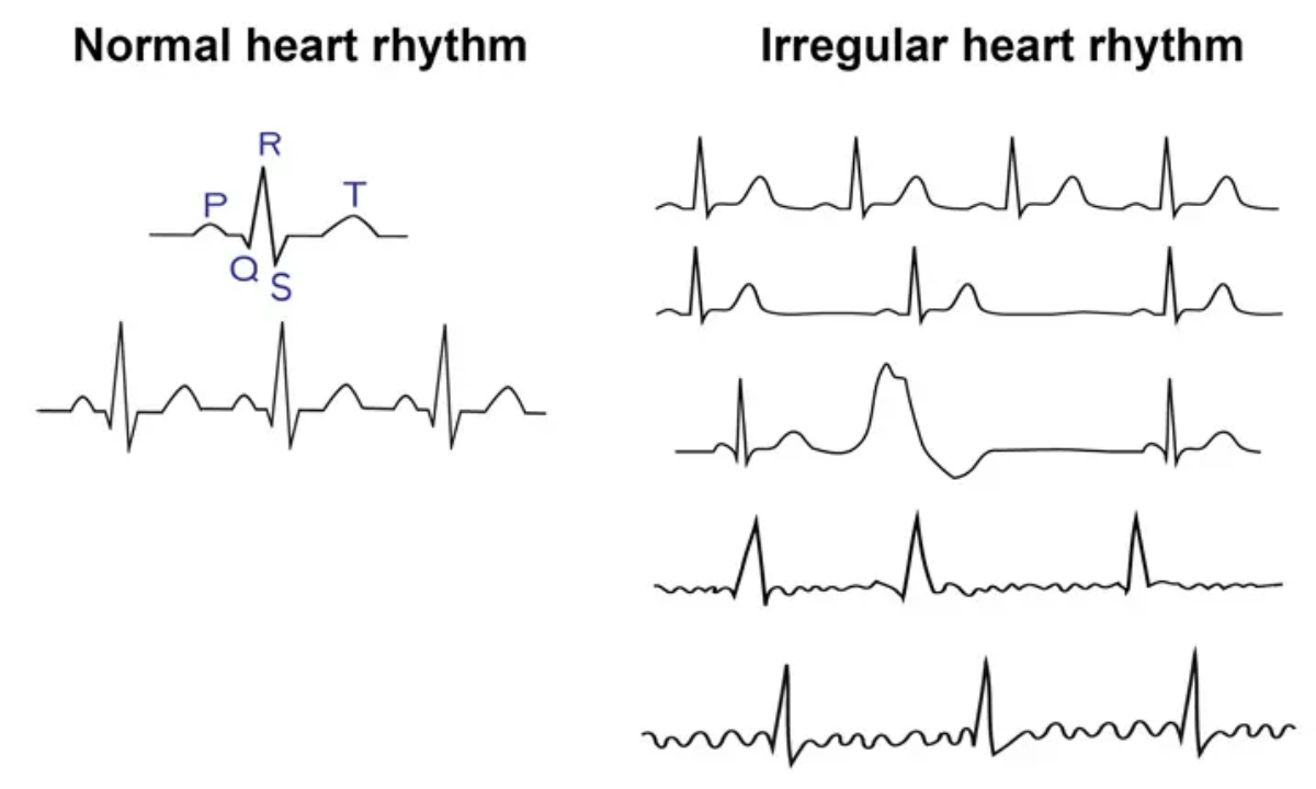 Abnormal heartbeat