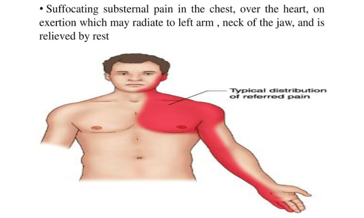 Radiation pain in left arm