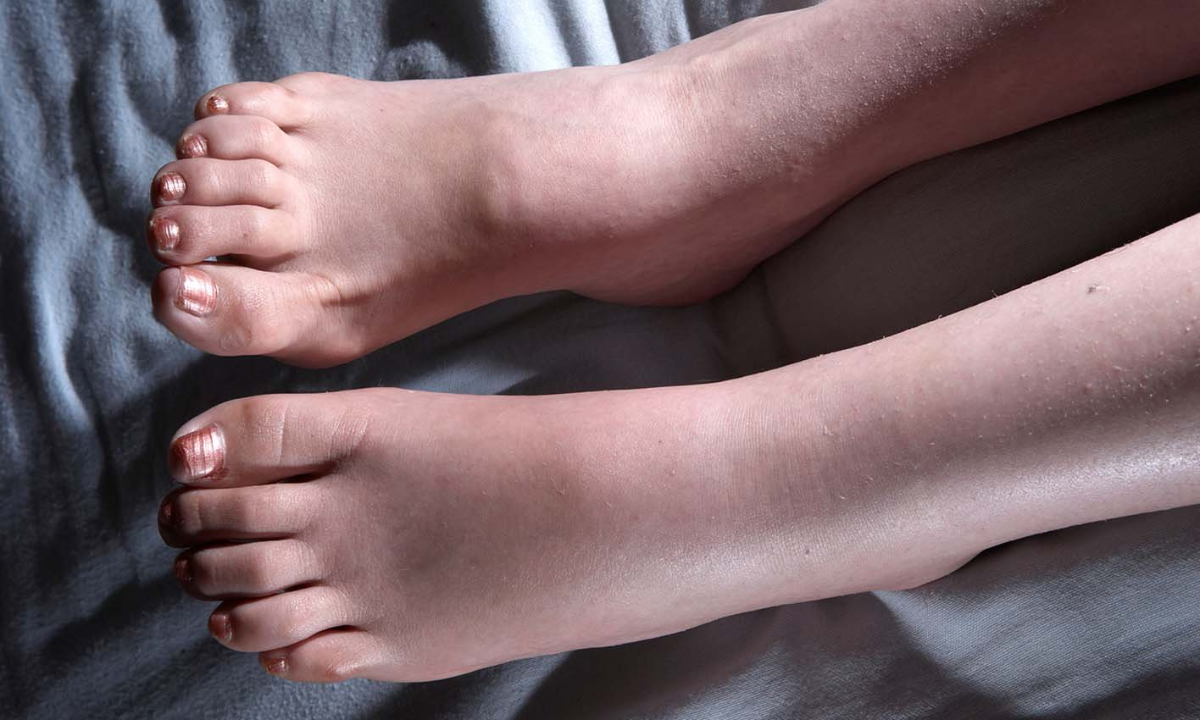 Swelling in Whole Foot