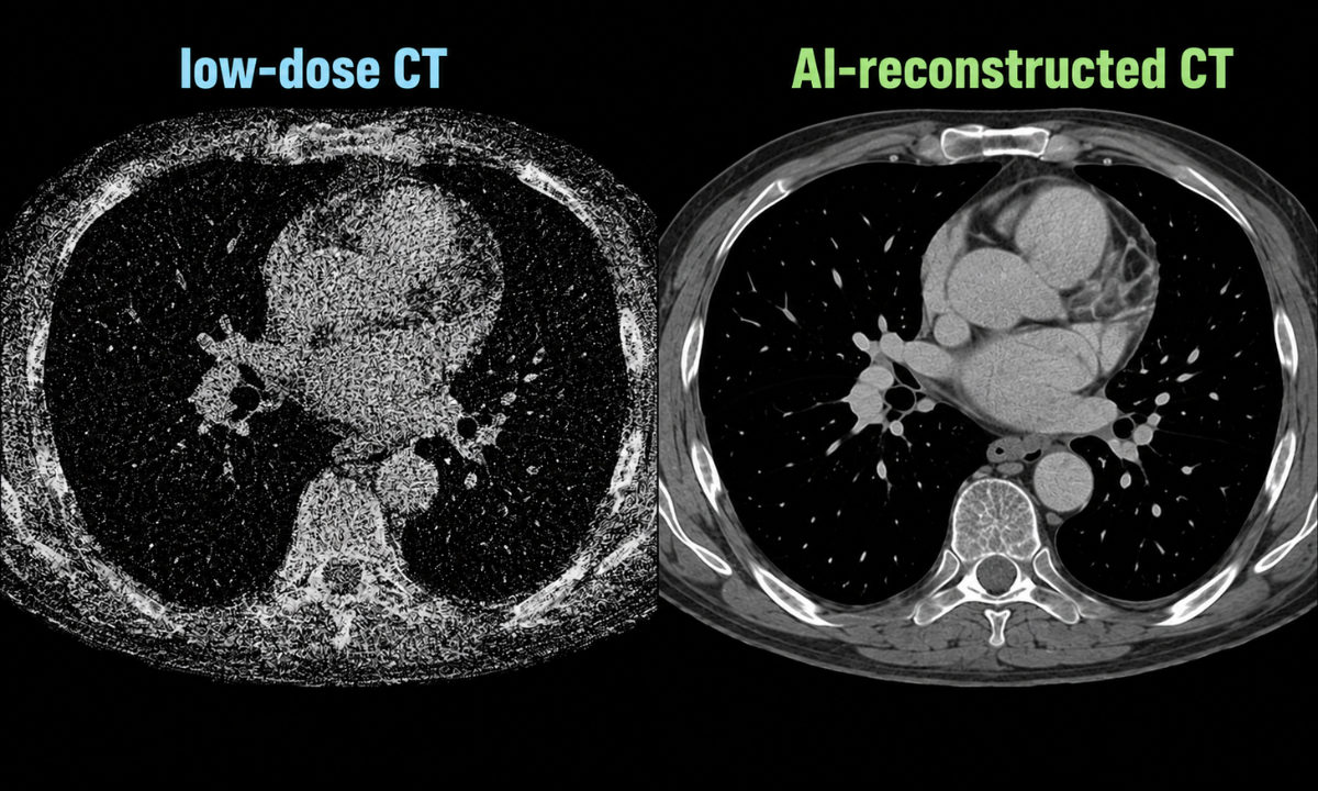 Low-Dose CT & Deep Learning Reconstruction