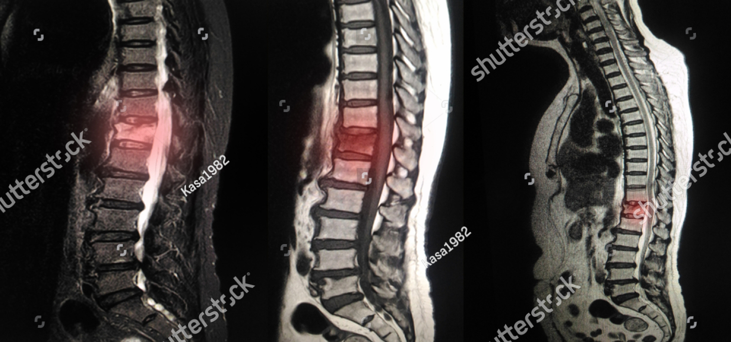Diagram showing spinal compression symptoms and nerve pressure on the spine